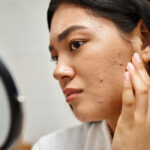 Tratamientos para el acné: Por qué solo una crema no es suficiente