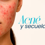 Acné y 4 secuelas importantes