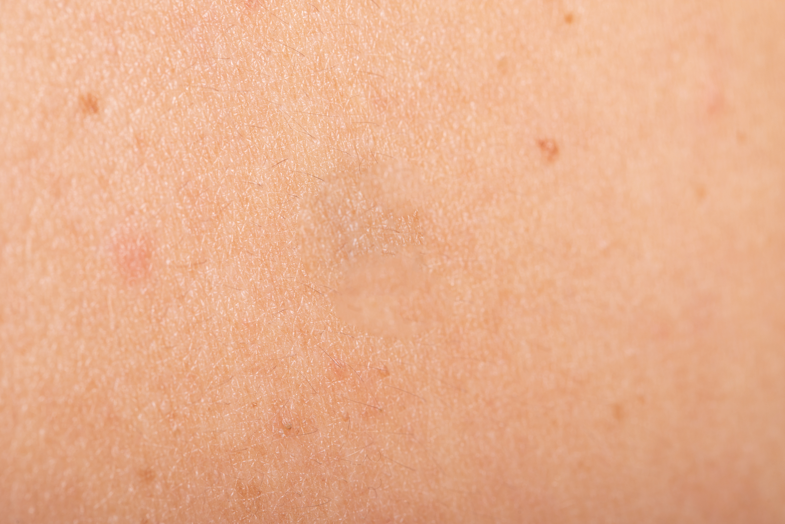 dermati_solucion_vinali_bola_piel