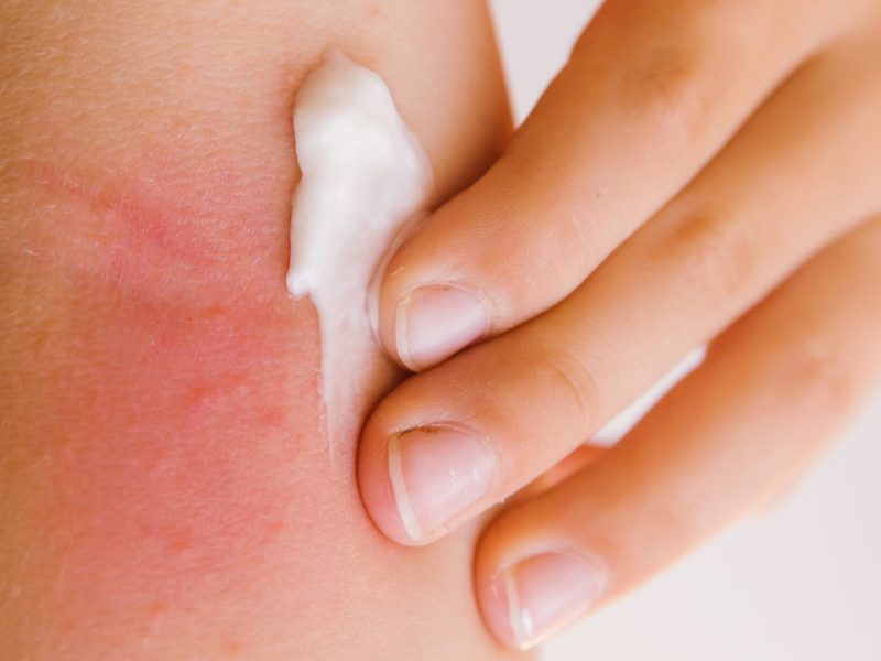 The child smears cream on the skin irritation. Care of the skin. Dry and irritated skin.