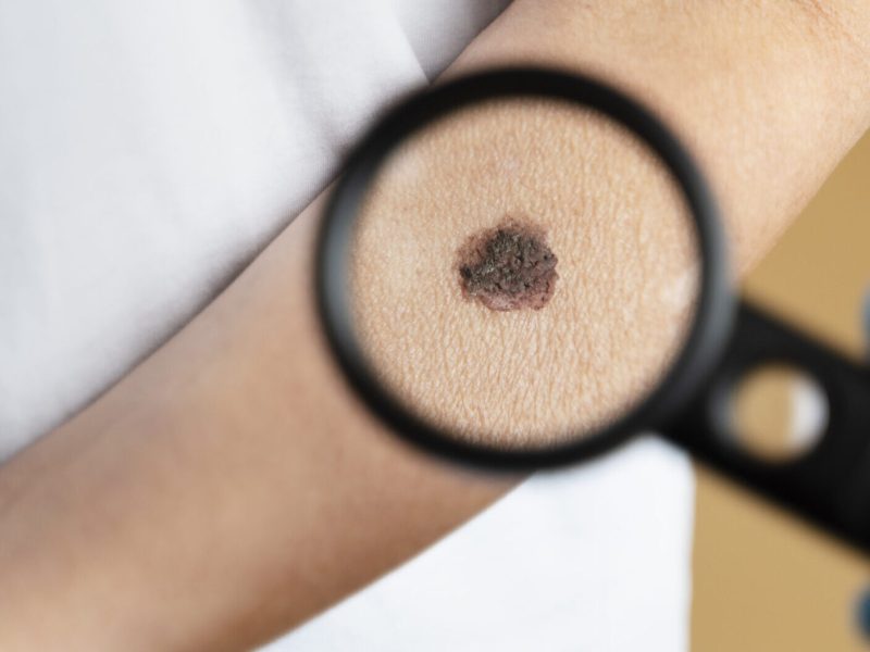 high-angle-magnifying-glass-mole