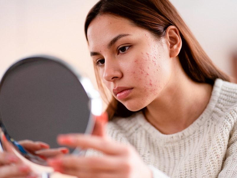 page-procedimientos-dermatologicos-acne-secuelas-banner-2