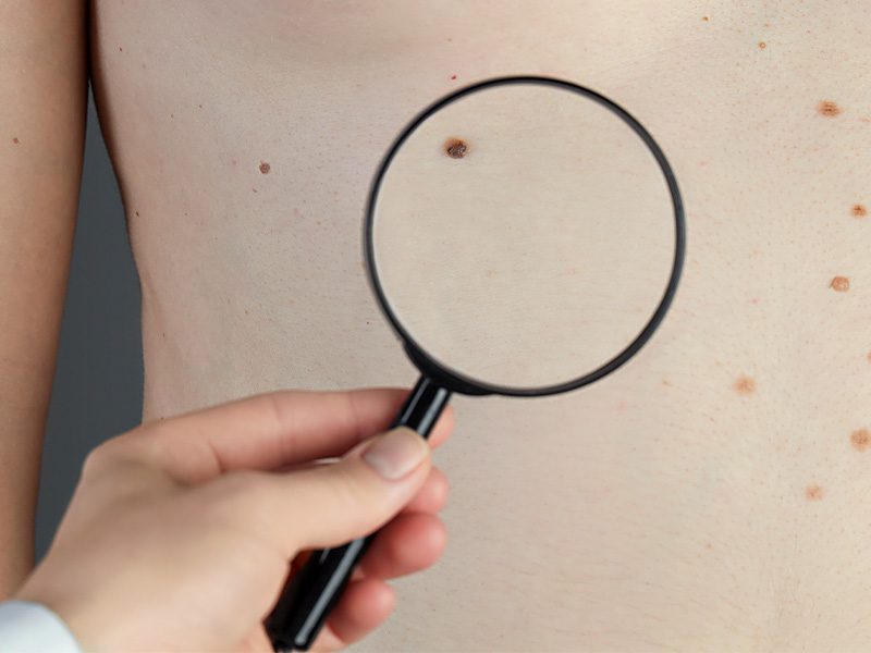 page-procedimientos-dermatologicos-acrocordones-banner-2