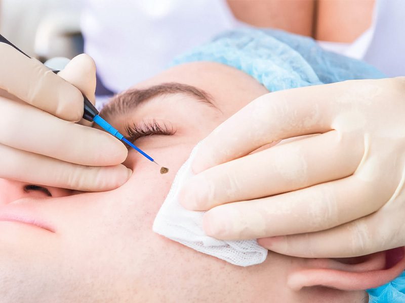 page-procedimientos-dermatologicos-acrocordones-banner-3