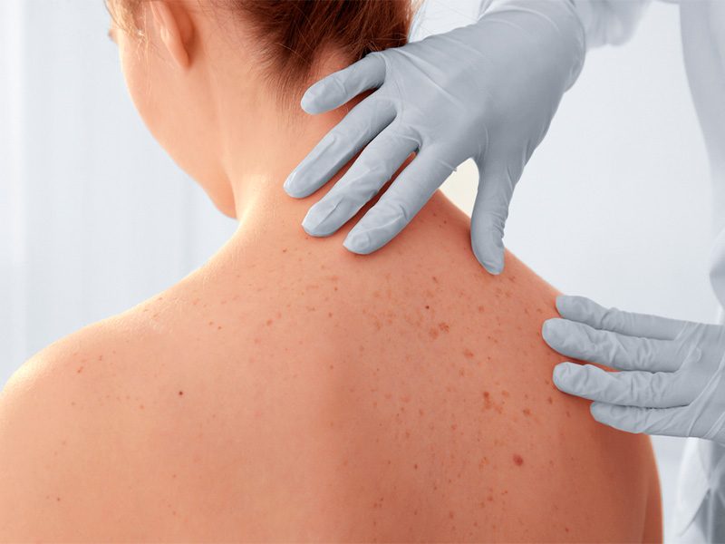 page-procedimientos-dermatologicos-cancer-piel-banner-2