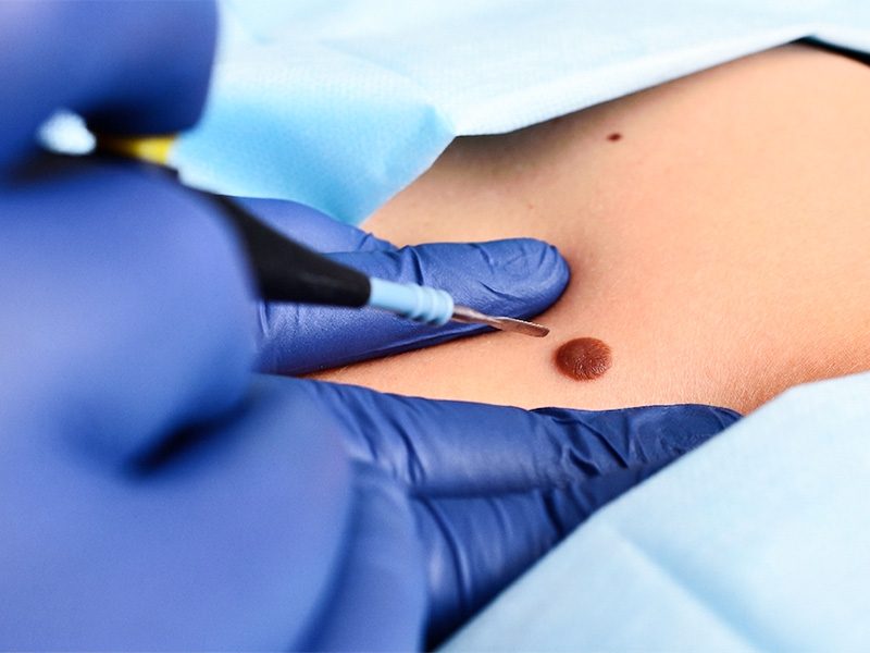 page-procedimientos-dermatologicos-cancer-piel-banner-3