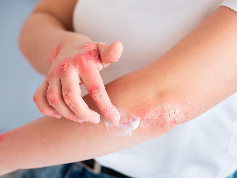page-procedimientos-dermatologicos-psoriasis-banner-3