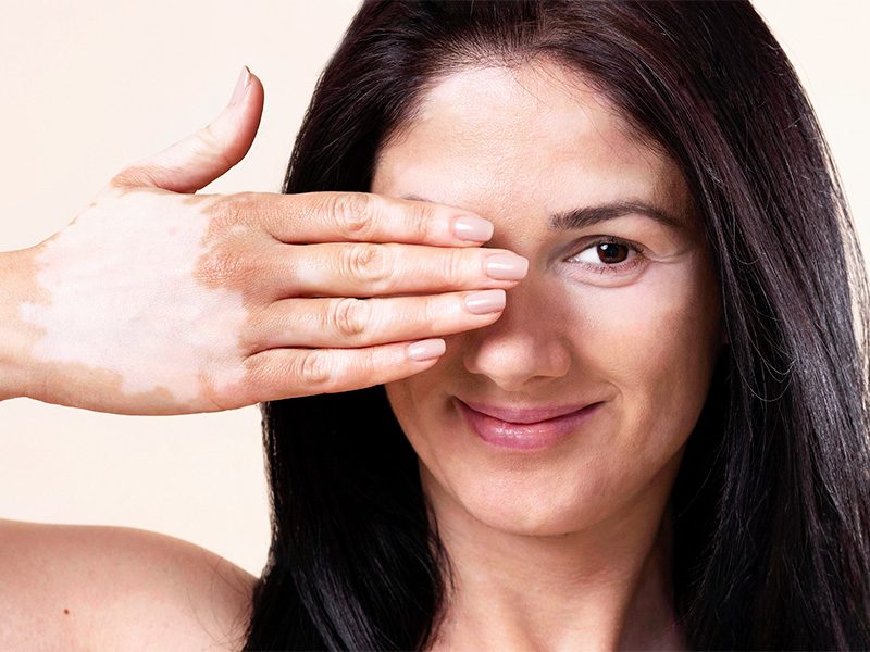 page-procedimientos-dermatologicos-vitiligo-banner-1