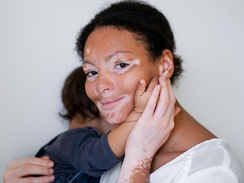 page-procedimientos-dermatologicos-vitiligo-banner-2