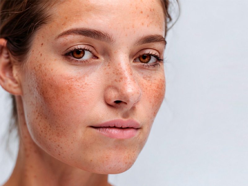 page-procedimientos-laser-lentigo-solar-banner-1