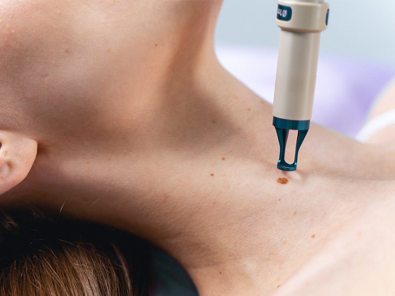 page-procedimientos-laser-lentigo-solar-banner-2