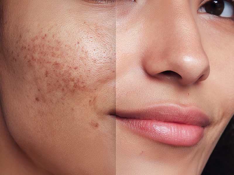 page-procedimientos-laser-lentigo-solar-banner-3