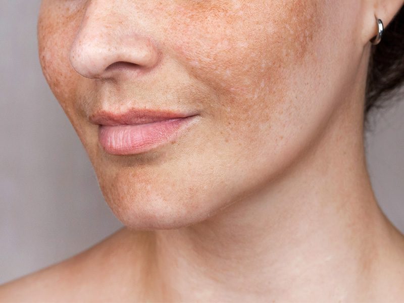 page-procedimientos-laser-melasma-banner-1