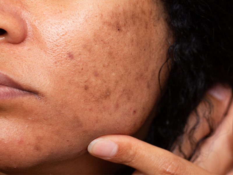 page-procedimientos-laser-melasma-banner-2