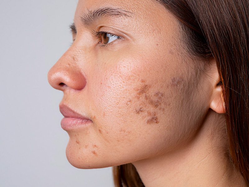 page-procedimientos-laser-melasma-banner-3