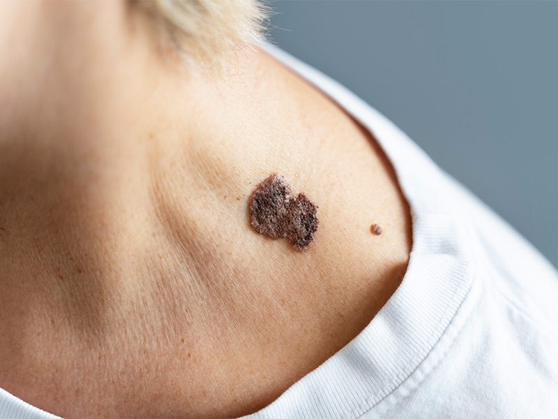 page-procedimientos-laser-queratosis-seborreica-banner-1