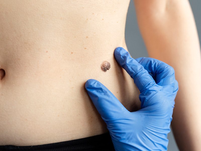 page-procedimientos-laser-queratosis-seborreica-banner-2