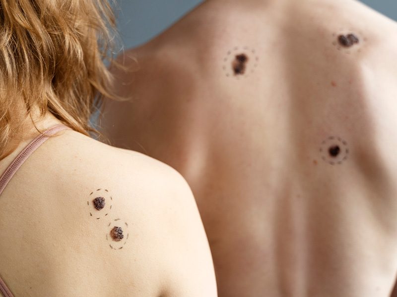 page-procedimientos-laser-queratosis-seborreica-banner-3