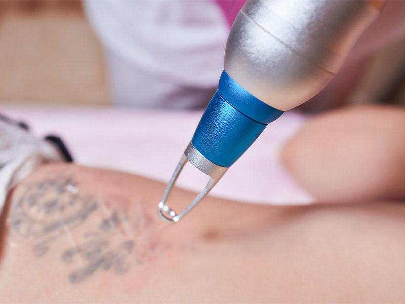 page-procedimientos-laser-retiro-tatuajes-banner-1
