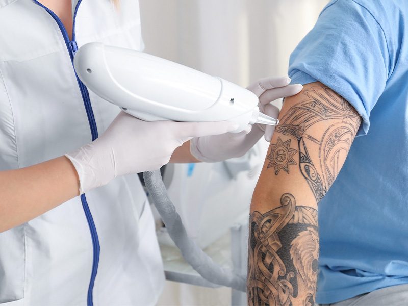 page-procedimientos-laser-retiro-tatuajes-banner-2