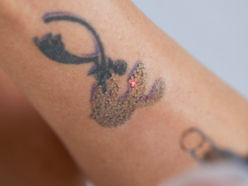 page-procedimientos-laser-retiro-tatuajes-banner-3
