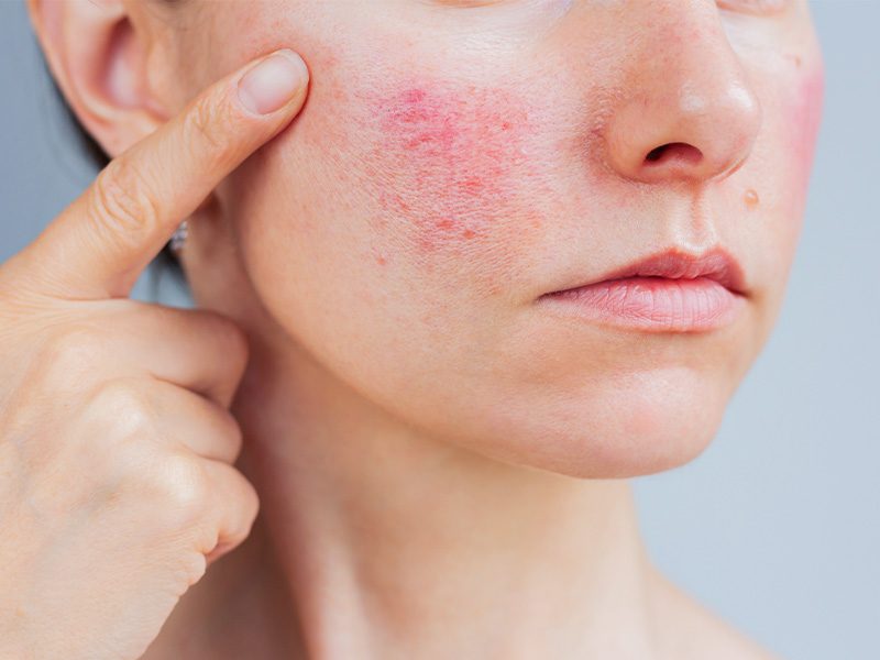 page-procedimientos-laser-rosacea-banner-1