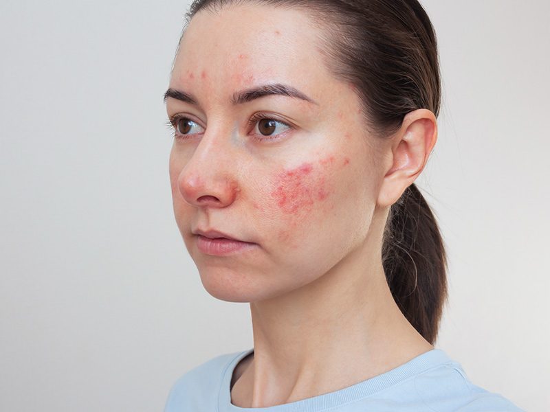 page-procedimientos-laser-rosacea-banner-2