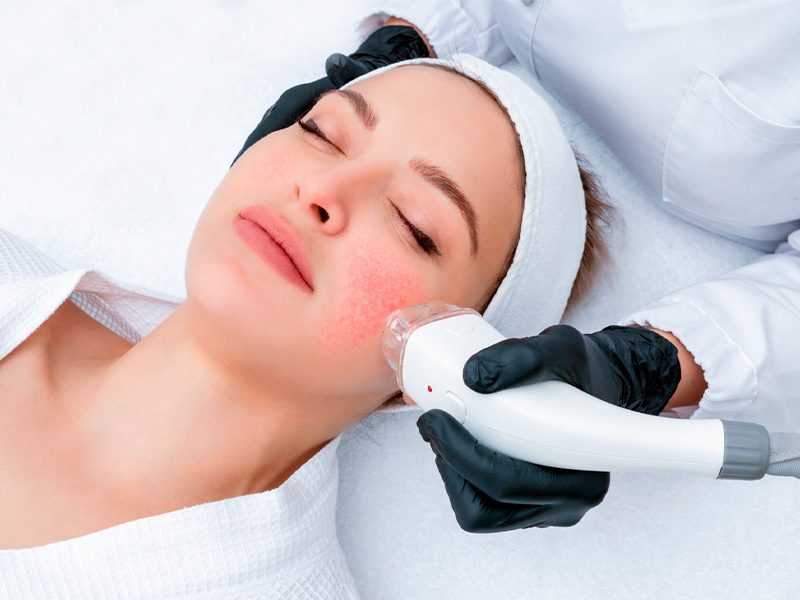 page-procedimientos-laser-rosacea-banner-3