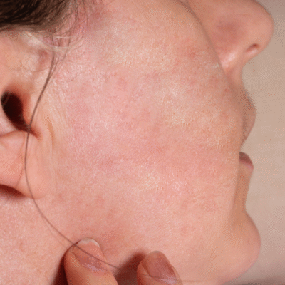 mujer_sin_rosacea_vinali_centro_dermatologico_cura_laser