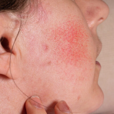 Closeup of female face with rubescent cheeks due to blotchiness